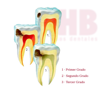 http://www.odontocat.com/arch/caries.jpg